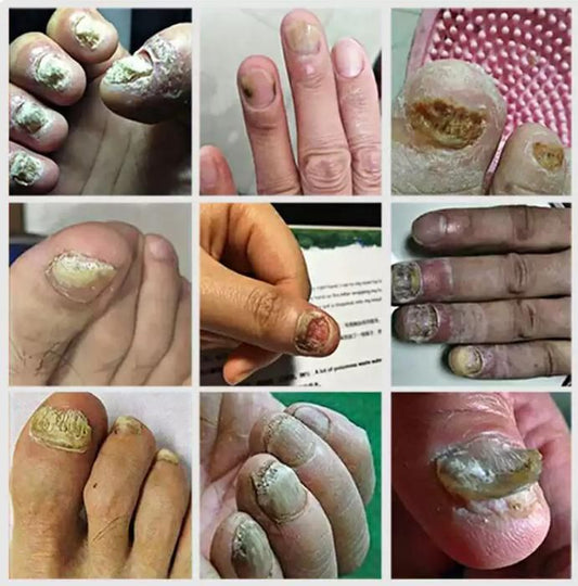 Ingrown Toenail Drops 60ml – Pack of 2